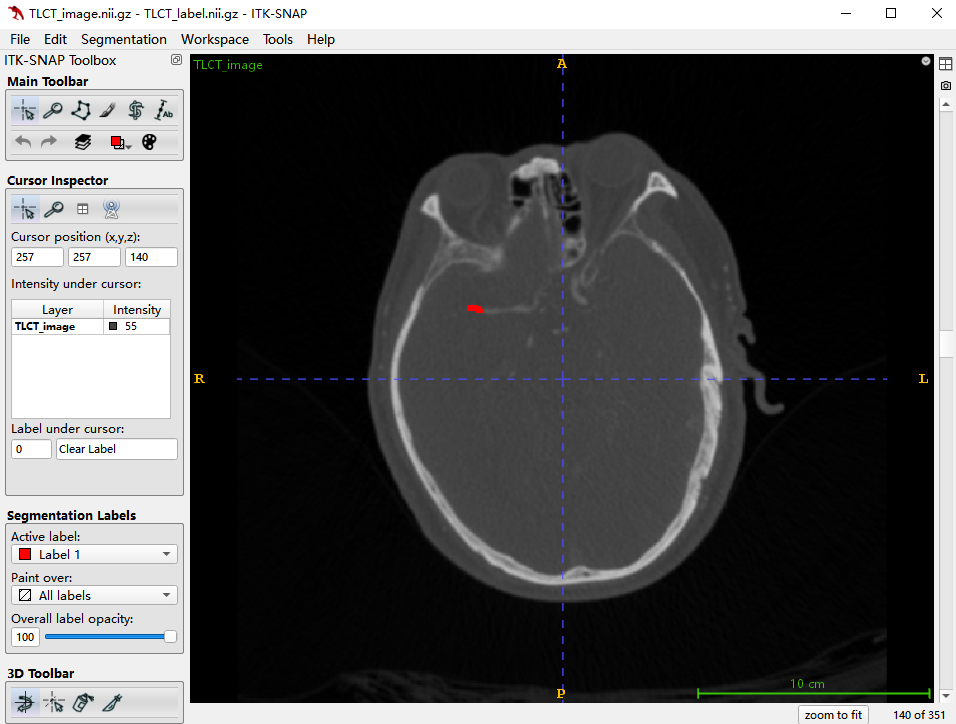 ITK-SNAP中脑部CTA影像与血栓标注分割