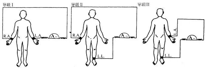 标准双极肢体导联电极接线示意