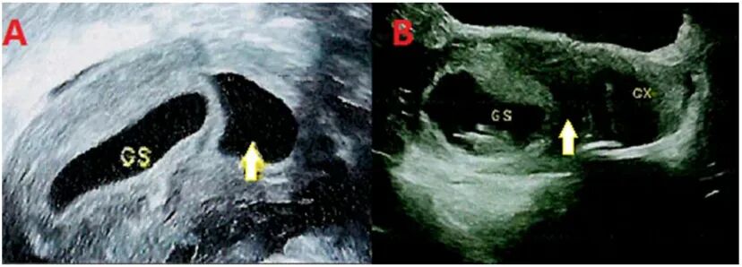 孕早期超声图像，显示GS（孕囊）及无回声区