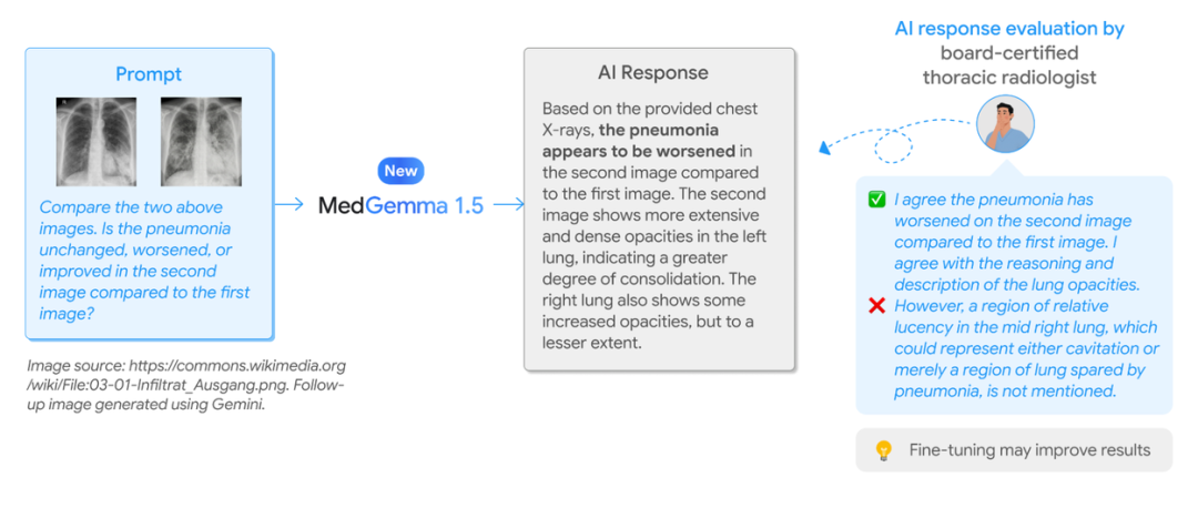 使用MedGemma 1.5解读胸部X光片纵向对比的示例及专家评估