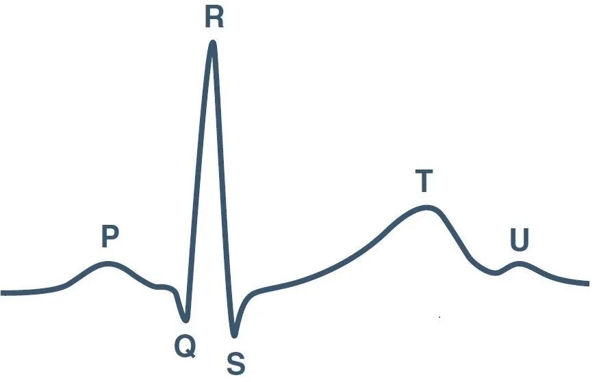 正常心电图P-QRS-T-U波群