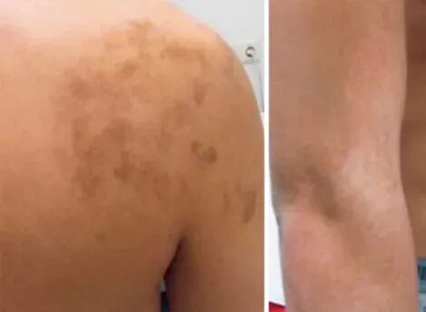 人体肩部和小腿皮肤，显示沿布拉什科线分布的色素沉着