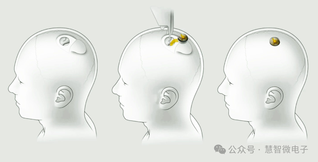 Neuralink的侵入式技术路线