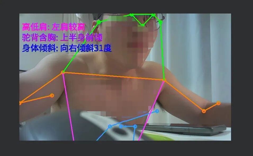 一名坐姿人物上半身图像，面部模糊处理，躯干和肩部被彩色关键点连线标注，左侧叠加文字显示高低肩、驼背含胸、身体倾斜等体态分析结果。